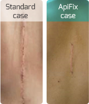 The ApiFix System is a non-fusion minimally invasive treatment alternative for Adolescent Idiopathic Scoliosis (AIS).
