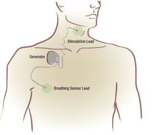 Inspire therapy works inside your body, and with your natural breathing process, to treat sleep apnea. It continuously monitors your breathing patterns while you sleep. Based on your unique breathing patterns, the system delivers mild stimulation to key airway muscles, which keeps the airway open.