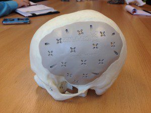 The patient-specific implant fit perfectly into place.