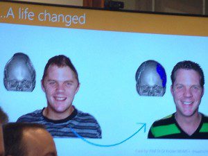 A before and after of a patient with a custom implant.