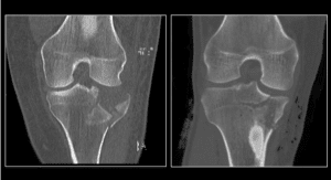 This is an ultra-low dose radiation CT scan of a fracture of the tibial plateau (left) compared to a conventional dose CT scan.