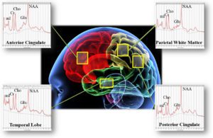 PTSD_brain