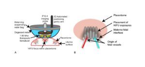 Ultrasound waves may offer a new tool for splitting abnormal blood vessels in the placenta that affect some twin pregnancies, a new study shows in sheep.