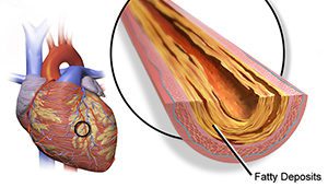 heart disease