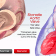 aortic valve