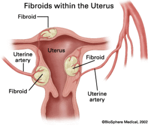 uterine-fibroids-2