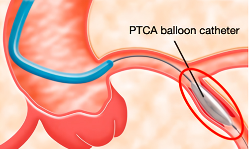 Asahi Intecc catheter PTCA