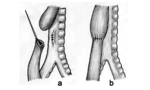 esophageal atresia