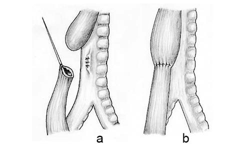 esophageal atresia