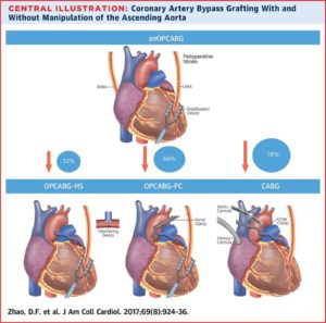 no-touch heart bypass surgery cabg