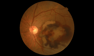 age-related macular degeneration