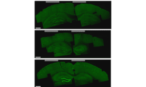 Deep brain stimulation Non-invasive brain stimulation