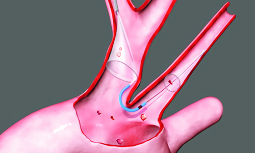 Emboline Protection Device Embolic protection devices: How to design a successful clinical trial