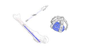 Integer ortho instruments orthopedic