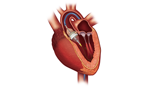 Edwards Lifescience Sapien 3 TAVR