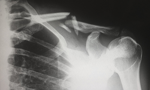 X-rays X-ray
