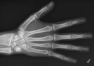hand x-ray