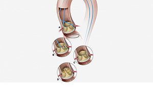 NIH BASILICA TAVR NHLBI