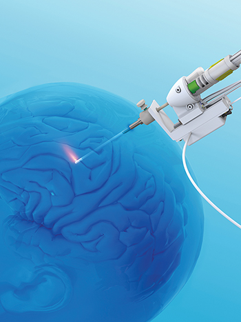 Monteris Medical NeuroBlate