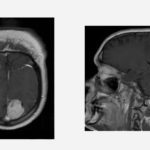 Bill Betten MRI brain tumor medtech expert product development DeviceTalks Minnesoate