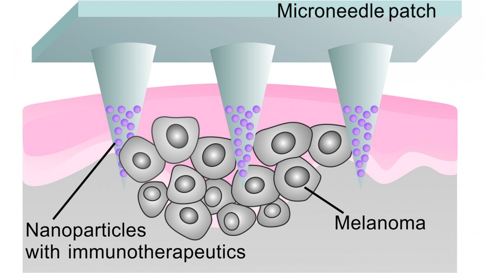 Microneedle Patch Delivers Localized Immunotherapy to Melanoma ...