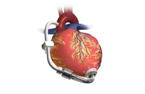 LVAD
