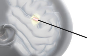 Schott LITT Laser interstitial thermal therapy glass diffusers