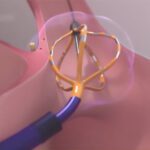 Boston Scientific Farapulse