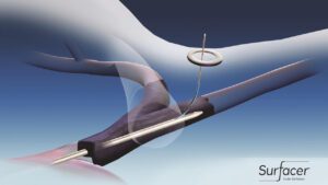 Bluegrass Vascular Technologies Surfacer Inside-Out