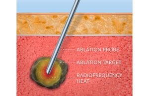 An illustration of ablation showing the ablation probe radiating radiofrequency heat