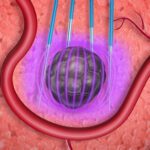 An illustration showing how pulsed field ablation uses electronic fields to kill cells using irreversible electroporation.