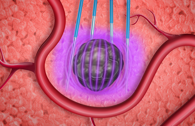 Electrical energy in medicine RF ablation, PFA and electroporation