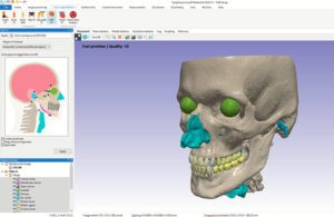 A screenshot of a patient's head scanned into computer software