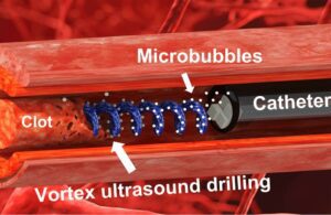 Jiang vortex ultrasound blood clot