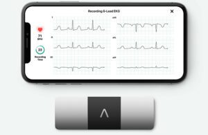 AliveCor's KardiaMobile 6L device next to a smart phone displaying cardiac activity.