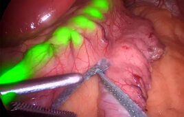 Endolumik's gastric calibration tube shining light through stomach tissue as viewed through a surgical scope.