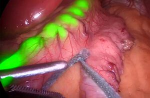 Endolumik's gastric calibration tube shining light through stomach tissue as viewed through a surgical scope.