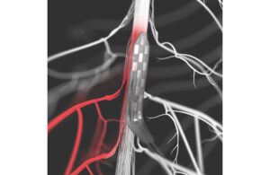 An illustration showing an electrode placed on the spinal cord for stimulation.