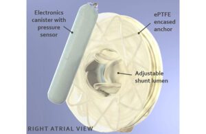 An illustration of Adona Medical's adjustable nitinol heart shunt sensor device.