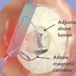 An illustration showing Adona Medical's electromagnetic catheter for adjusting the size of its heart shunt device by heating shape memory nitinol.