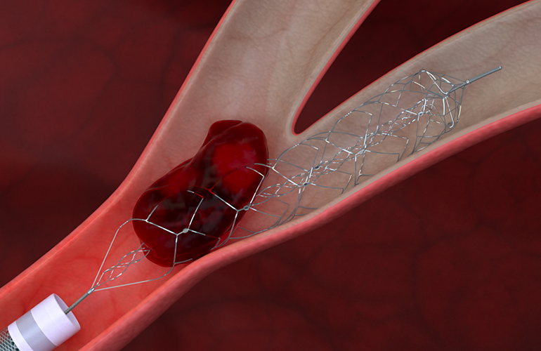 An illustration of Johnson & Johnson's Cerenovus Embotrap III revascularization device — delivered via a Prowler EX microcatheter —capturing a blood clot.