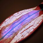 An illustration of an AVS Pulse balloon catheter breaking up arterial calcification while expanding the blood vessel.