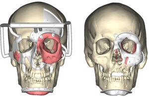 Surgical planning images showing transplant guides for the world's first eye and partial face transplant recipient and the tissue donor.