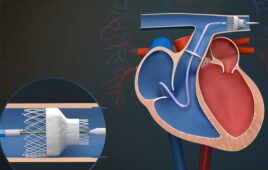 An illustration of Heartpoint's IntelliStent system, which is designed to use minimally invasive catheter delivery to place adjustable stents to adjust blood flow in the pulmonary arteries.