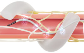 An illustration showing the Medtronic Symplicity Spyral renal denervation (RDN) ablation catheter expanded inside the renal arteries and ablating nerves in the vessel walls to treat hypertension.