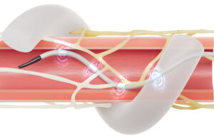 An illustration showing the Medtronic Symplicity Spyral renal denervation (RDN) ablation catheter expanded inside the renal arteries and ablating nerves in the vessel walls to treat hypertension. 