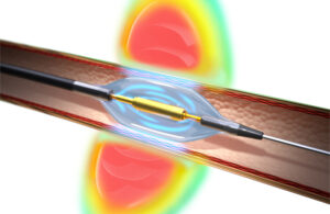 An illustration showing the Recor Medical Paradise ultrasound RDN system's balloon catheter ablating nerves in the walls of the renal artery.