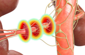 An illustration showing the Recor Medical Paradise ultrasound RDN system's balloon catheter ablating nerves in the walls of the renal artery.