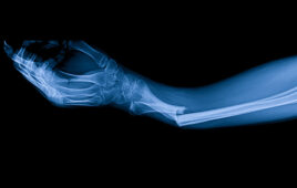 An X-ray of a broken arm.