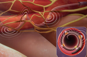 An illustration of Medtronic's Symplicity Spyral renal denervation (RDN) ablation catheter